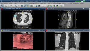 Интерфейс PACS IW и реализация виртуальной бронхоскопии